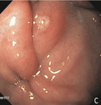 Эрозии желудка: Неполная эрозия (II тип), подтип IIb. Атлас эндоскопических изображений endoatlas